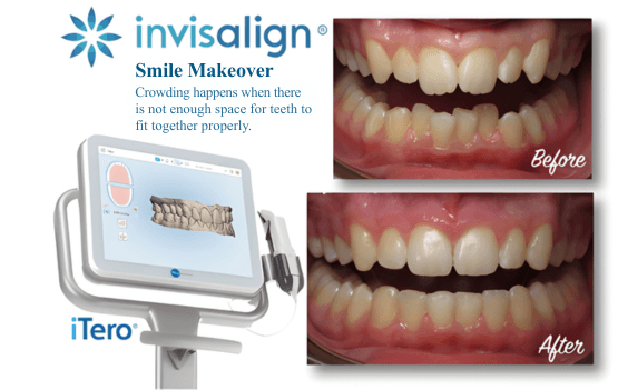 Invisalign Process Step 1