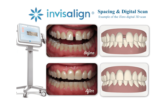 Invisalign Process Step 2